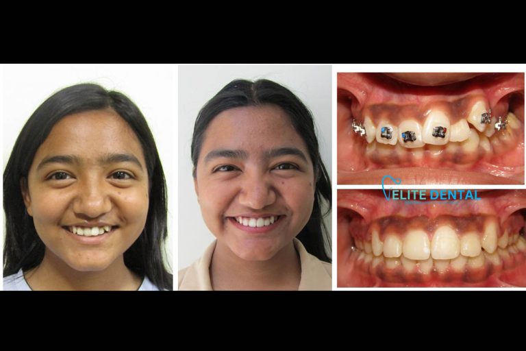 Teeth braces in Nepal