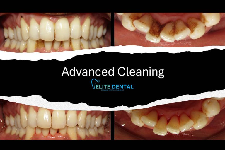 Teeth braces in Nepal