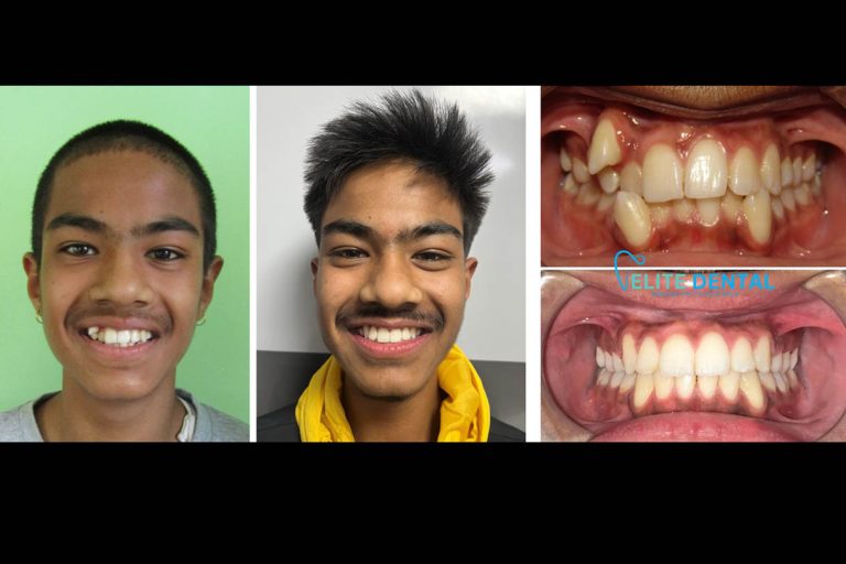 Teeth braces in Nepal