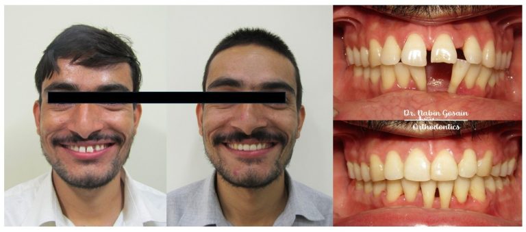 Teeth braces in Nepal